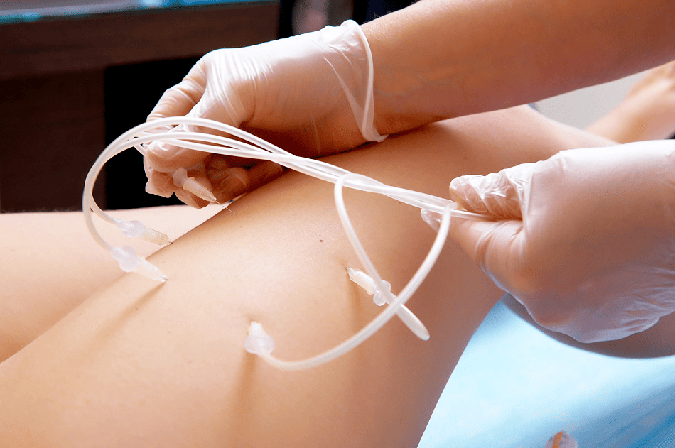 Озонотерапия